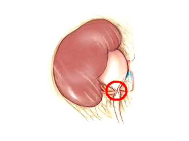 Pyeloplasty Surgery