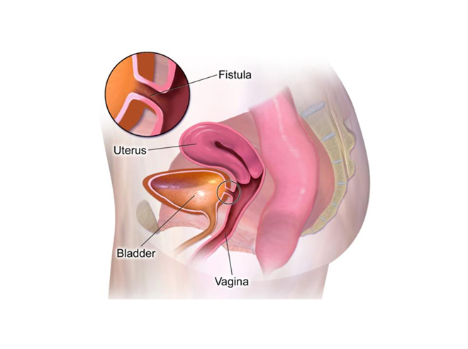 Vesicovaginal Fistulae (VVF) Reconstructive Surgery