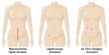 Myomectomy Surgery