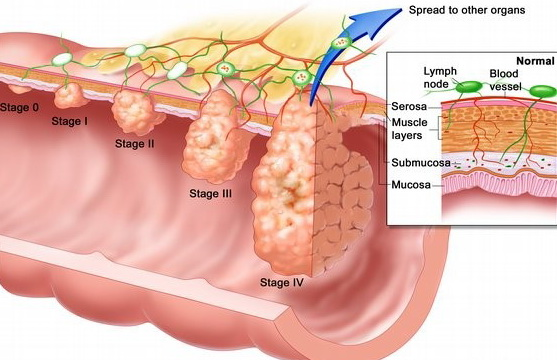 Robotic-Assisted Colorectal Surgery