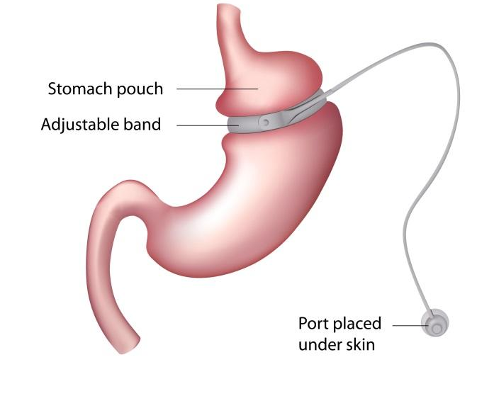 Gastric Banding