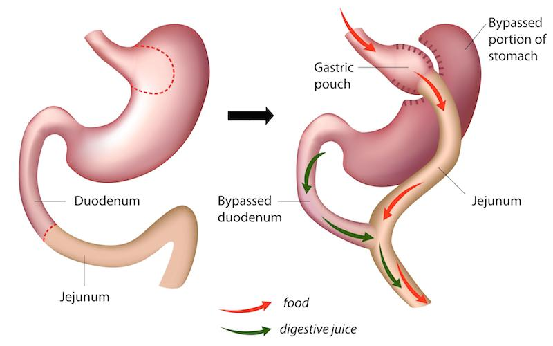 gastric-bypass