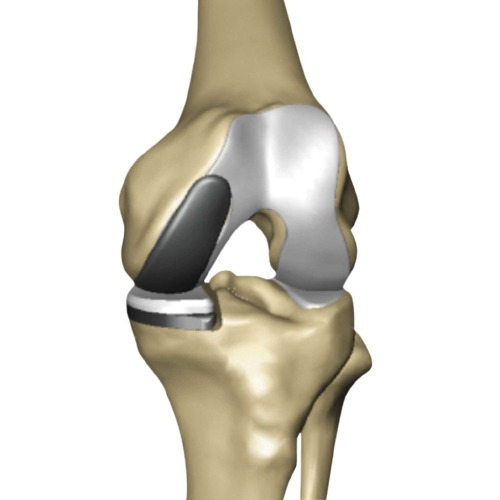  mako partial surgery