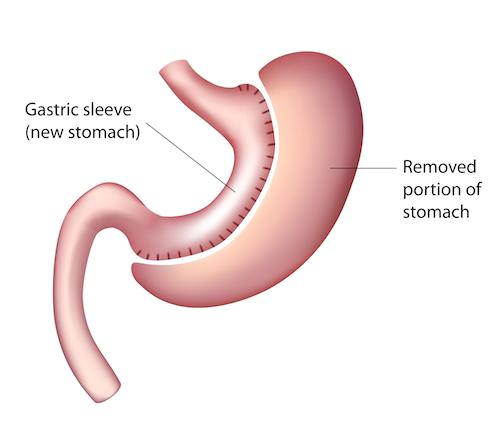 Gastric Banding