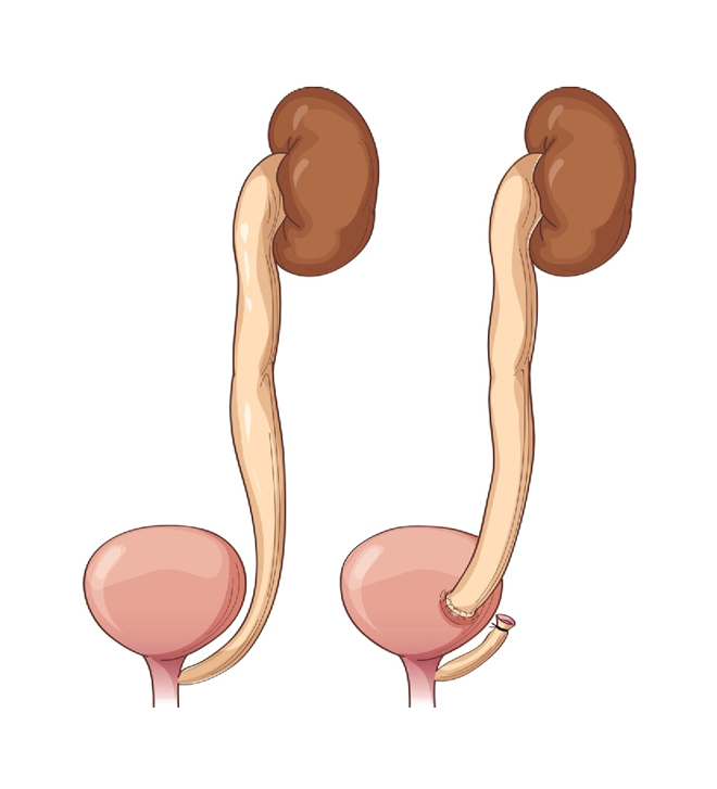 Vesicovaginal Fistulae (VVF) Reconstructive Surgery